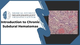 Introduction to Chronic Subdural Hematomas [upl. by Ahsien299]