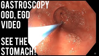 Gastroscopy What happens during the procedure [upl. by Dalila]