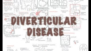 Diverticular Disease diverticulitis  Overview [upl. by Halley253]