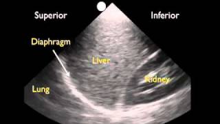 How To Ultrasound Detection of Pleural Fluid Case Study Video [upl. by Nedaj]