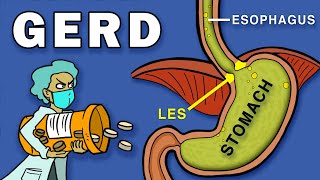 Gastroesophageal Reflux Disease GERD [upl. by Enomis]