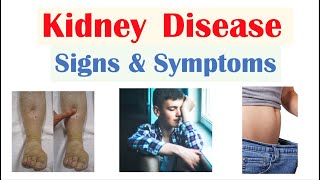 Kidney Renal Disease Signs amp Symptoms ex Peripheral Edema Fatigue Itchiness [upl. by Earb]