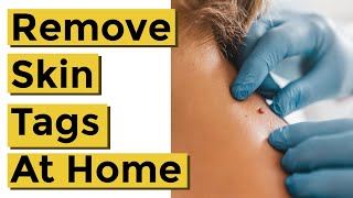 How to Quickly and Easily Remove Skin Tags at Home Using Things You Already Own [upl. by Mccafferty]