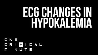 ECG Changes in Hypokalemia  One Critical Minute 1CM [upl. by Occor]