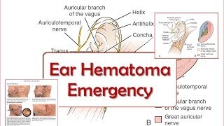 Ear Hematoma Emergency [upl. by Aloysius]