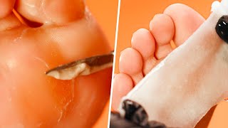 Chiropodist and Podiatrist in Norwich  Nail Surgery [upl. by Letreece149]