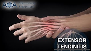 AOA Orthopedic Specialists  Extensor Tendinitis [upl. by Nailluj905]