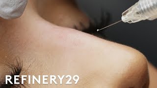 Why I Got This 15 Minute Nose Job  Macro Beauty  Refinery29 [upl. by Anerak]