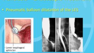 Treatment of Achalasia [upl. by Hepzi]