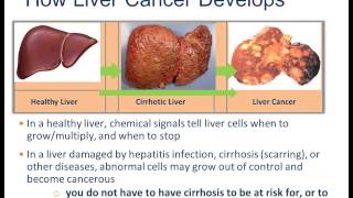 TREATMENT OPTIONS FOR LIVER CANCER by Dr Robert Gish [upl. by Baram]