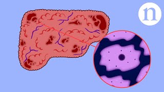 Cirrhosis of the liver Diagnosis [upl. by Croteau]