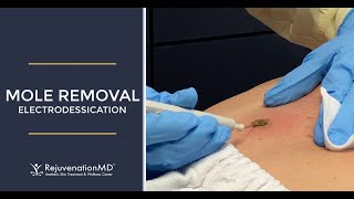 Electrodessication to Remove Seborrheic Keratosis [upl. by Noffets]