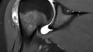 Bursitis of shoulder  First Look MRI [upl. by Alicia]