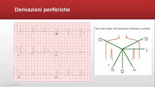 5 Understanding Arrhythmias  Cardiac Ablation [upl. by Kado]