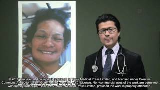 Choreaacanthocytosis a case report  video abstract 95882 [upl. by Atinra]