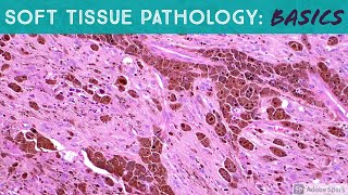 Basic Soft Tissue Pathology amp Bone Tumor Cases Explained by a Sarcoma Pathologist [upl. by Einiffit]