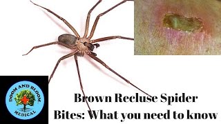 Brown Recluse Spider Bites What you need to know [upl. by Mchugh]