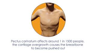 Pectus Excavatum Surgery Sams Story [upl. by Ocinom]