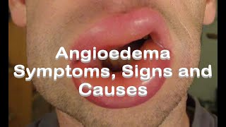 Angioedema  Symptoms Signs and Causes [upl. by Notsur]