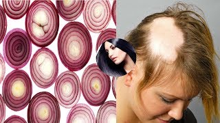 Grandmas SECRET Recipe for Hair growth in 15 days Onion Juice And Coconut Oil Pack treatment [upl. by Sileas462]