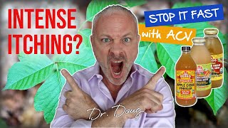 Poison Ivy Remedy STOP Itching FAST  Dr Doug Willen [upl. by Barbara-Anne]