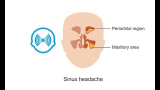 Sinus Headache vs Migraine [upl. by Ziguard115]