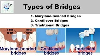 Types Of Dental Bridges [upl. by Aenyl738]