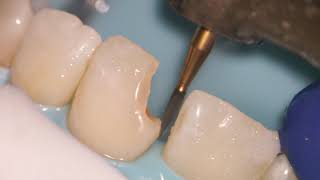 Teeth Bonding  Front tooth filling EXPLAINED [upl. by Anielram]