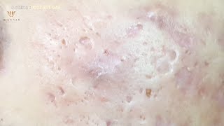 Extraction quotacnequot at hien van spa360 Cao Xuân Thắng [upl. by Mutat]