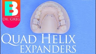 Quad Helix Expander for Braces  Invisalign [upl. by Chura]