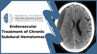 Endovascular Treatment of Chronic Subdural Hematomas [upl. by Eelarual]