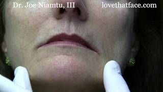 Botox Injection to DAO corner of mouth by Dr Joe Niamtu III [upl. by Wildermuth634]