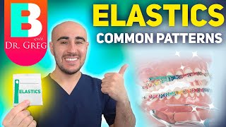 BRACES ELASTICS Most Common Patterns for Braces [upl. by Eduardo949]