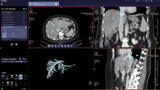 syngovia Liver Analysis [upl. by Lohner]