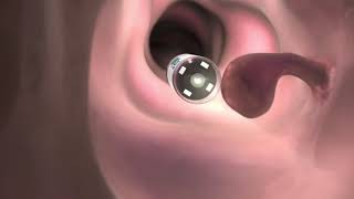 Upper Endoscopy for GERD Best Practice Advice from ACP [upl. by Bezanson]