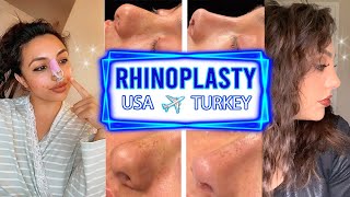 BULBOUS THICK SKIN RHINOPLASTY VLOG TURKEY  DR RESIT BURAK KAYAN  NOSE JOB TURKEY  Hadia [upl. by Maxwell]