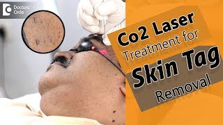 Skin Tag Removal in seconds using Cardondioxide Laser  Procedure  Dr Rajdeep Mysore [upl. by Faline]