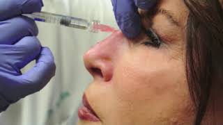 Nonsurgical Rhinoplasty [upl. by Lesya]