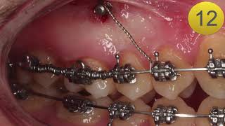 Técnica Distalamiento Molar Minitornillo [upl. by Pascoe]