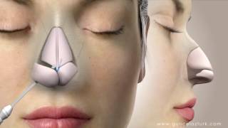 Rhinoplasty Nose Job Video Animation  Guncel Ozturk MD  DRGO [upl. by Sillad]