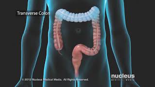 Colon Problems Diverticular Disease [upl. by Ggerk]