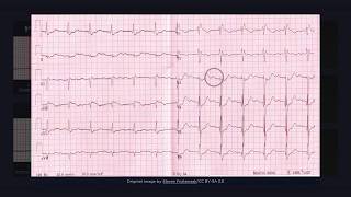 First Degree Atrioventricular Block ECG [upl. by Garrik243]