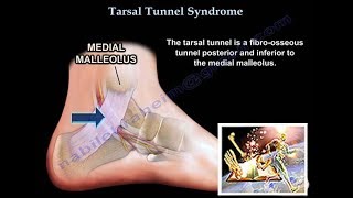 Tarsal Tunnel Syndrome  Everything You Need To Know  Dr Nabil Ebraheim [upl. by Atlee]