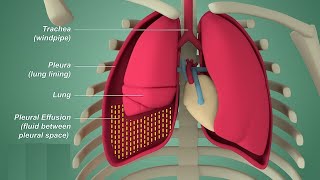 Pleural effusion  Internal medicine Etiology Clinical Features Diagnosis and Treatment Usmle [upl. by Amara905]