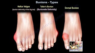 Bunions Types  Everything You Need To Know  Dr Nabil Ebraheim [upl. by Siurad]