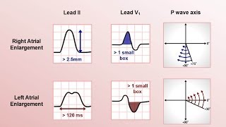 Intro to EKG Interpretation  Chamber Enlargement [upl. by Yarak873]