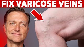 How to Treat Varicose Veins Naturally – Dr Berg [upl. by Tigges923]