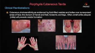 Porphyria cutanea tarda PCT  Biochemistry usmle step 1 webinar lecture [upl. by Tallu132]