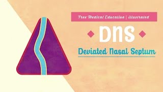 What is Deviated Nasal Septum DNS [upl. by Anemaj914]