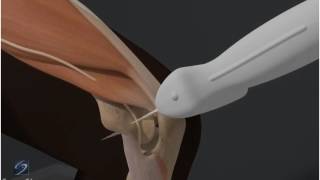 How To Elbow Ulnar Nerve 3D Video [upl. by Maroney]